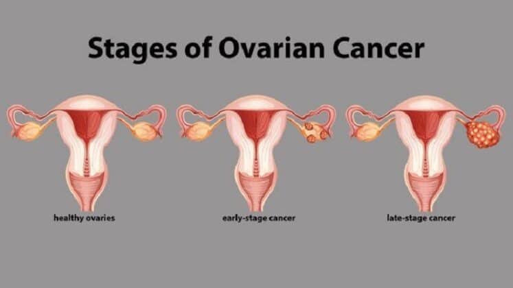 ovarian-cancer-after-hysterectomy-is-it-feasible-health-cart-hub