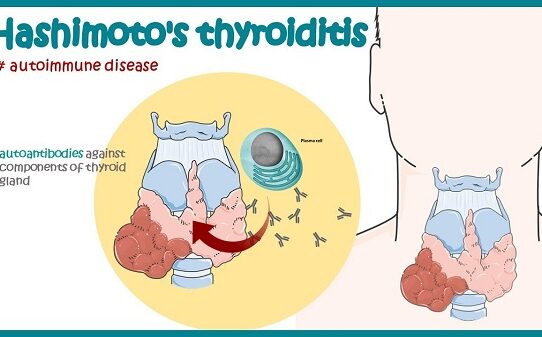 Hashimoto's Disease