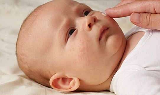 Does My Baby Have Eczema