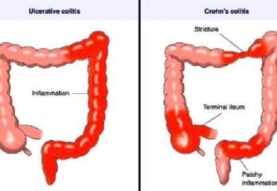 Understanding Crohn’s