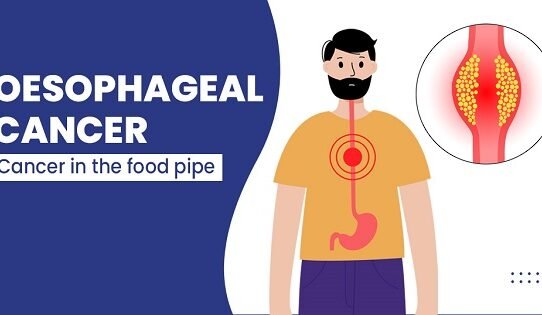 Oesophageal cancer